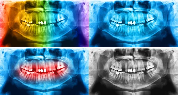 X-ray teeth mandible human skull