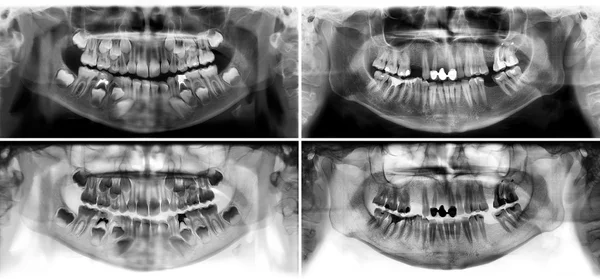 Panoramic dental x-ray tooth\'s of young man of 30 thirty and child of 7 seven years