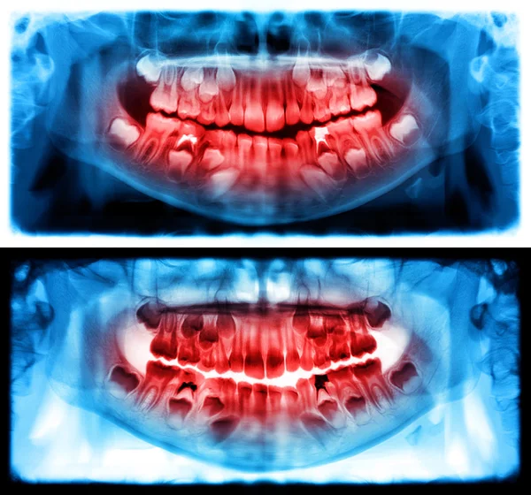 Panoramic dental x-ray of child of seven 7 years