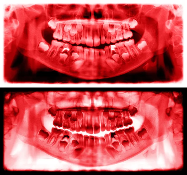 Red panoramic dental x-ray of child of seven 7 years