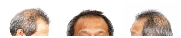 Hair loss , Male head with hair loss symptoms, set 3, front, lef