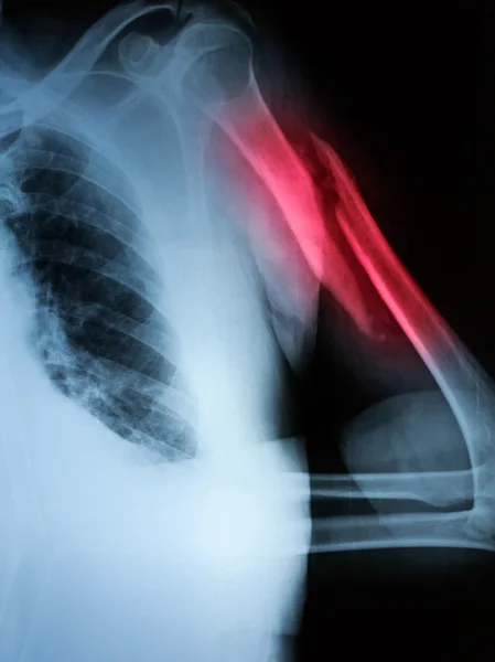 X-ray image of fracture of upper arm bone