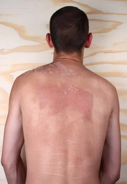Sunburned back body