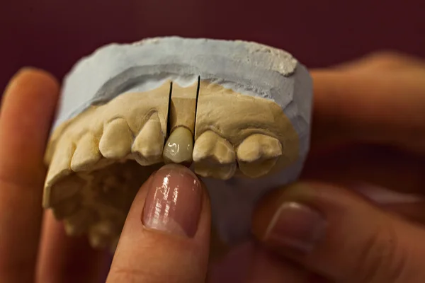 Dental Molds of Human Teeth