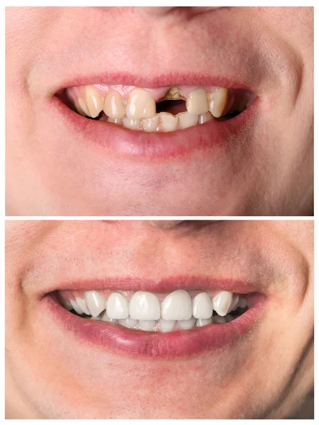 Incisive tooth restoration before and after treatment