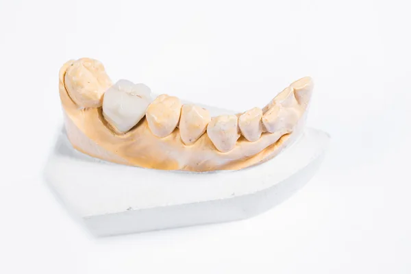Dental crowns and tooth