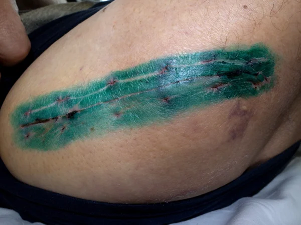 Scar.  Replacing of the devastated hip joint for  the hip endoprosthesis
