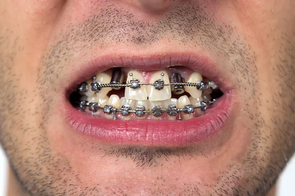 Open mouth with brackets