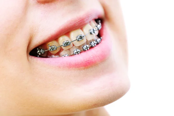 Teeth with braces, beautiful female smile