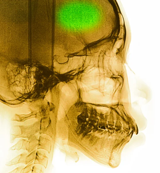 X-Ray scan human for teeth