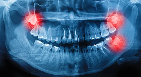 Film X-Ray human teeth scan