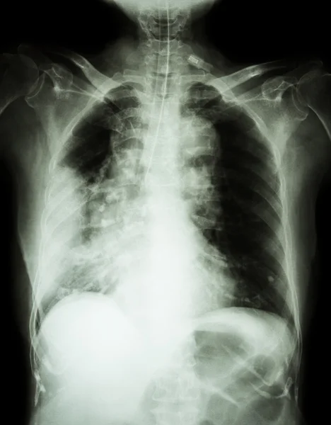 Lung cancer .  Film chest x-ray show right lung mass , wide mediastinum , pneumonia and right pleural effusion