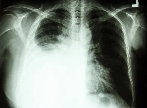 Pleural effusion due to lung cancer