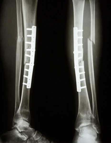 Fracture shaft of tibia and fibula