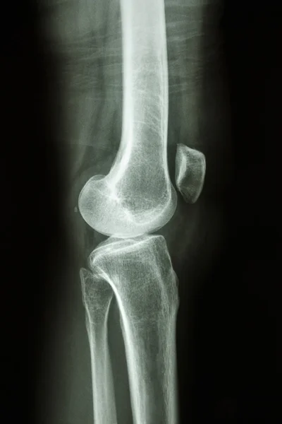 Normal human\'s knee joint