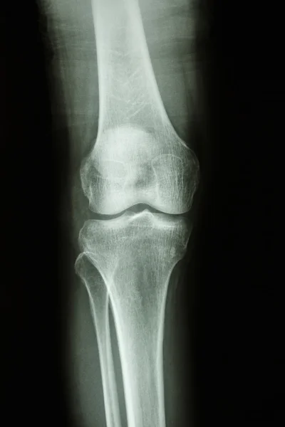 Normal human's knee joint