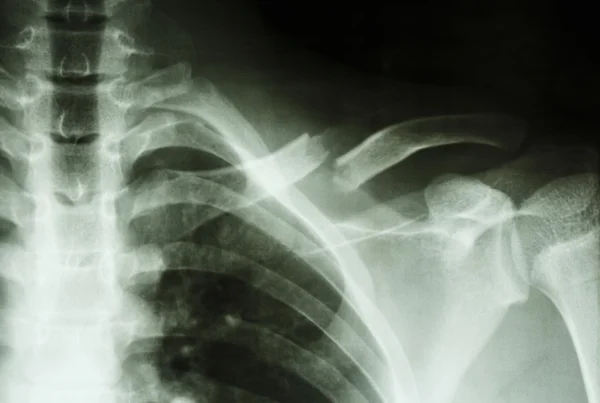 Fracture left clavicle