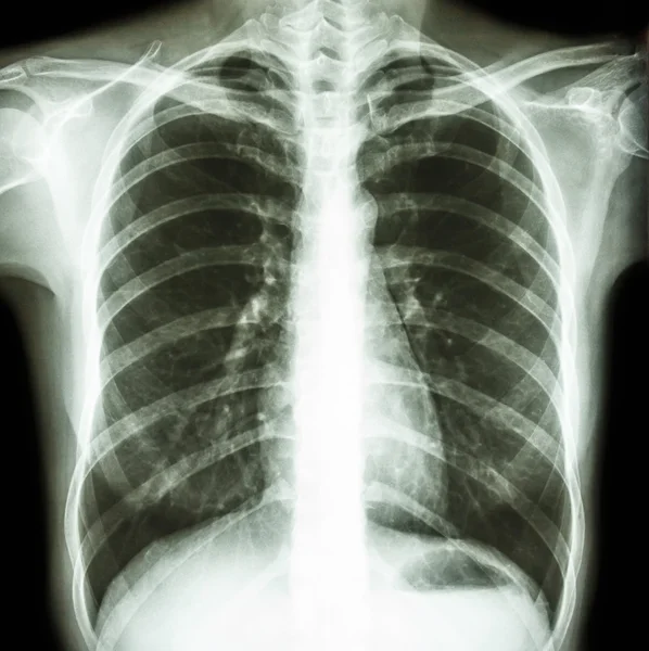 Normal human's chest