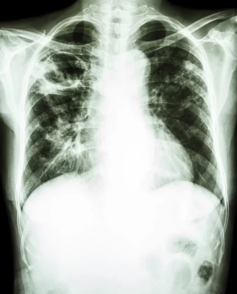 Mycobacterium tuberculosis infection (Pulmonary Tuberculosis)
