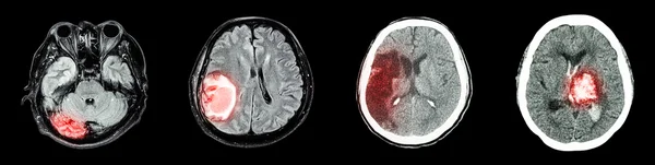 Collection CT scan of brain and multiple disease (Left to Right  :  Normal brain,Brain tumor,Cerebral infarction,Intracerebral hemorrhage)