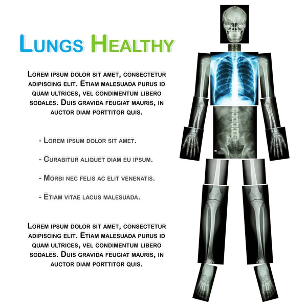 Lung healthy (X-ray Whole body : skull head neck spine shoulder chest thorax lung pulmonary heart rib arm elbow forearm wrist hand finger back abdomen pelvis hip thigh knee leg ankle foot heel )