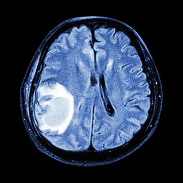 MRI brain : show brain tumor at right parietal lobe of cerebrum