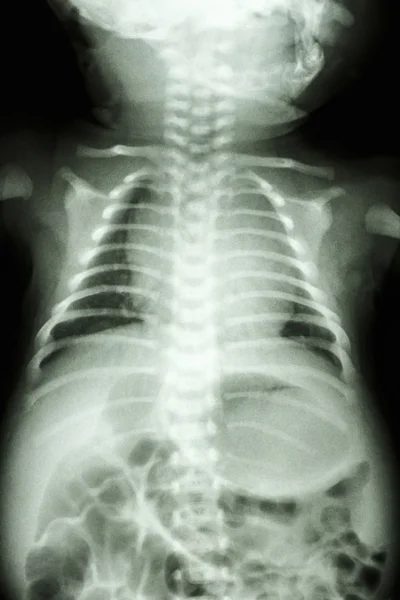 Normal chest of infant