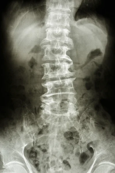 Bent lumbar spine and spurs of old people
