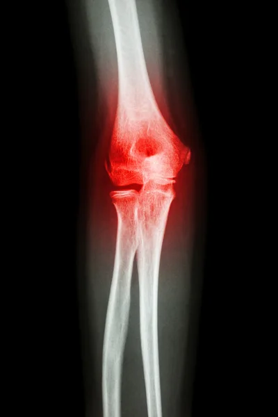 X-ray human\'s elbow and arthritis (Gout , Rheumatoid)