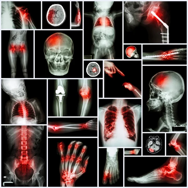 Collection of X-ray multiple part of human,Orthopedic operation and multiple disease (Shoulder dislocation,Stroke,Fracture,Gout,Rheumatoid arthritis,Bronchiectasis,Osteoarthritis knee, etc )
