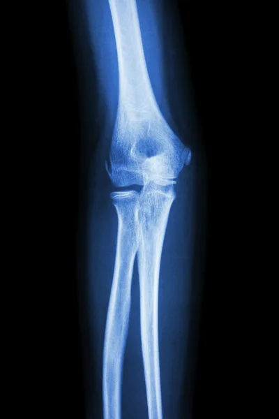 Film x-ray elbow AP : show normal human's elbow