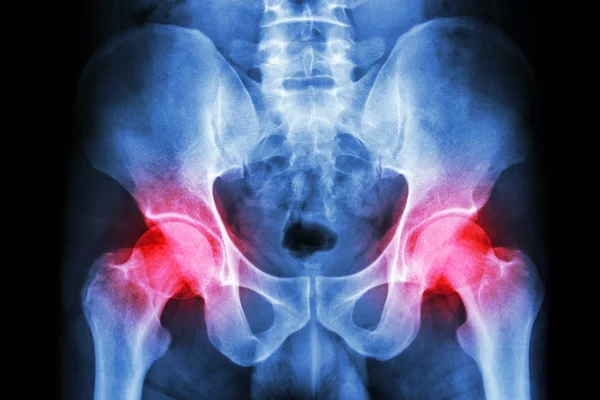 Film x-ray human\'s pelvis and arthritis at both hip joint (Gout , Rheumatoid)