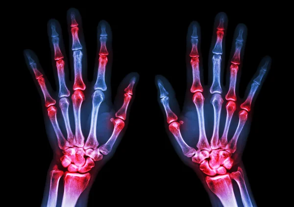Film x-ray both human\'s hands and arthritis at multiple joint (Gout,Rheumatoid)