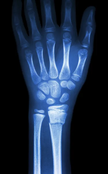 Fracture distal radius (forearm's bone)