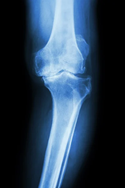 Osteoarthritis knee patient