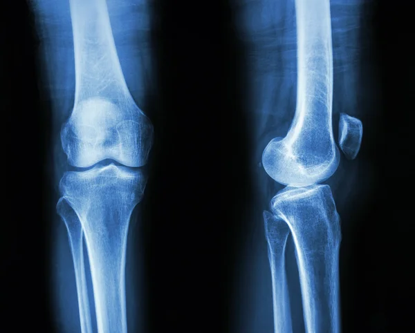 Normal human's knee