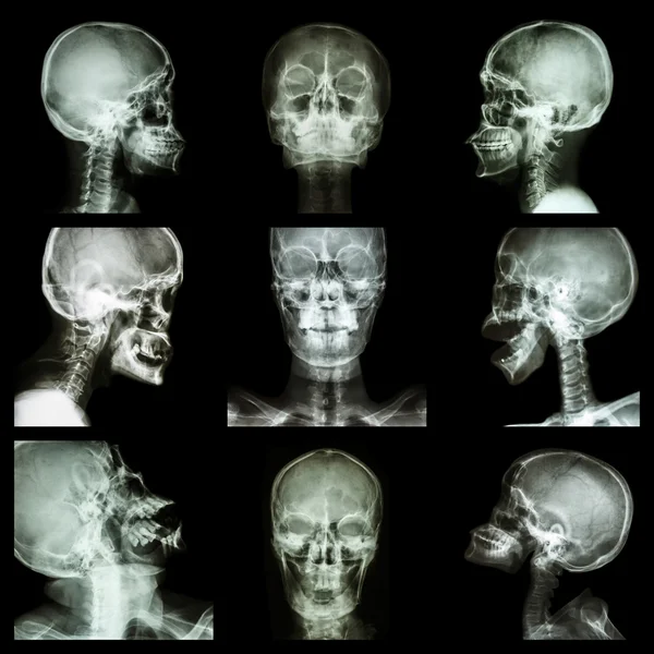 Collection of asian skull (Thai people)