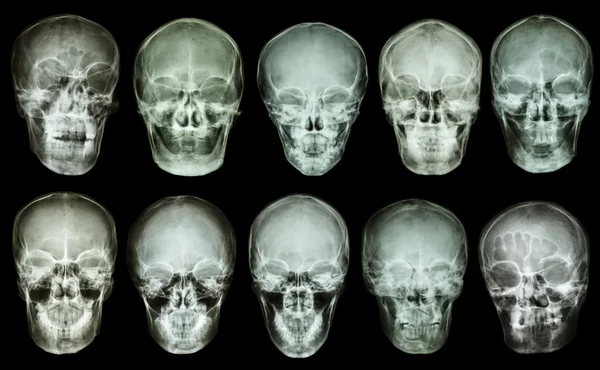 Collection of asian skull (anterior view) (Thai people)