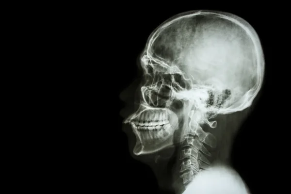 X-ray asian skull and blank area at left side