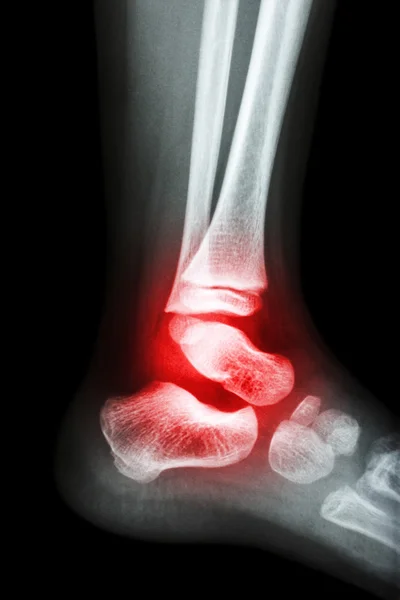 Film x-ray child's ankle and arthritis at ankle (Rheumatoid)
