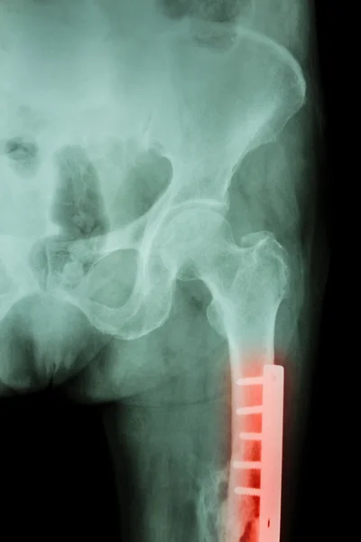 Film X-ray fracture femur(Thigh bone). It was operated and inter