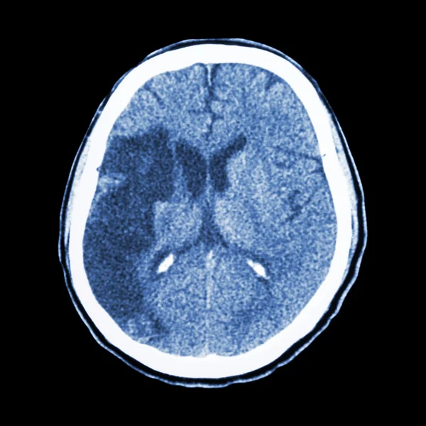 CT brain : show Ischemic stroke (hypodensity at right frontal-pa