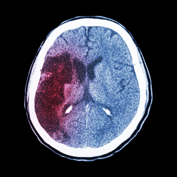 CT brain : show Ischemic stroke (hypodensity at right frontal-pa