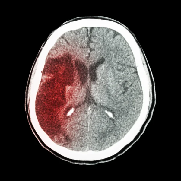 CT brain : show Ischemic stroke (hypodensity at right frontal-pa