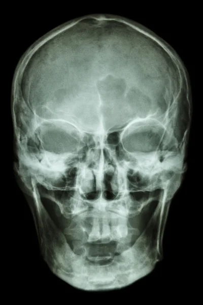 Normal human skull