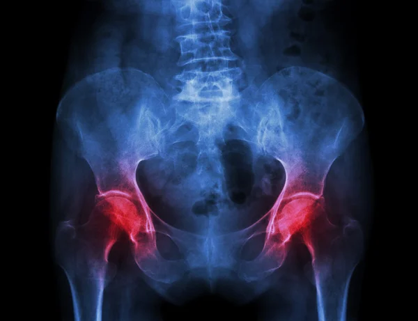 Film x-ray pelvis of osteoporosis patient and arthritis both hip