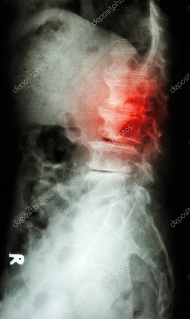 lumbar spondylosis thesis lumbar spondylosis thesis