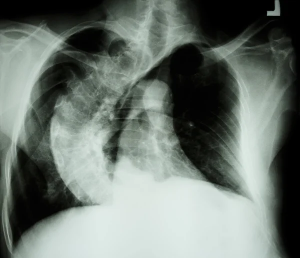 Scoliosis ( crooked spine ) X-ray chest of old people with  croo