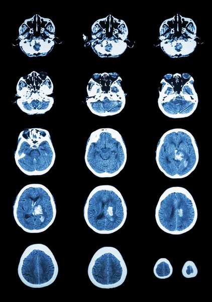 Hemorrhagic Stroke . CT scan (computed tomography) of brain ( c