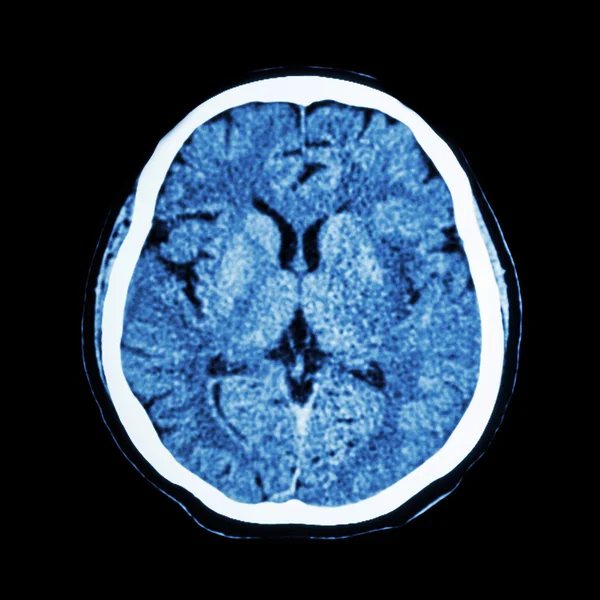 CT scan of brain : show normal human \'s brain ( CAT scan )